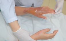 Bồn cầu phát nổ sau khi đổ hóa chất, người phụ nữ bỏng nặng