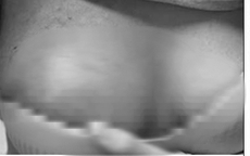 Hoại tử ngực vì tiêm chất làm đầy