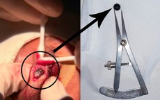 Viên bi sắt 6 mm nằm trong mí mắt nam sinh 15 tuổi suốt nhiều ngày