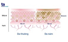 Giải quyết “nỗi ám ảnh” nám da
