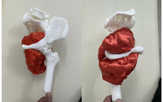 Đau háng kéo dài, người đàn ông bị phát hiện ung thư xương ác tính