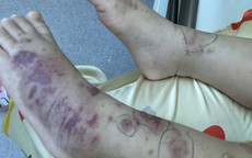 Chuyên gia cảnh báo về một căn bệnh nguy hiểm, lây lan nhanh, tỉ lệ tử vong cao