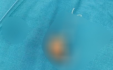 Người phụ nữ phát hiện sự thật sau 22 năm đặt vòng tránh thai