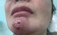 Tin quảng cáo “bật tông nhanh”, nhiều người biến dạng mặt vì làm đẹp cận Tết