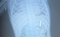 Dị vật sắc nhọn nằm trong dạ dày bệnh nhi 21 tháng tuổi