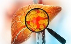 Đảo ngược gan nhiễm mỡ không cần ăn kiêng: Đột phá từ Mỹ