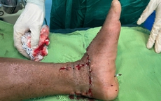 Lưỡi máy phát cỏ gãy, chém đứt lìa bàn chân người đàn ông