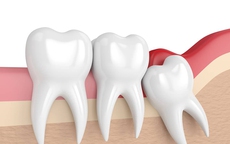 Nhổ răng khôn có được BHYT chi trả?