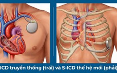 Lần đầu tiên đặt máy phá rung tim công nghệ mới