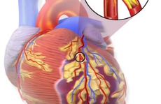 Protein liên quan với cơn đau tim