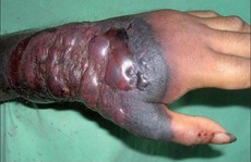 Dấu hiệu bạn nhiễm virus chết người Ebola
