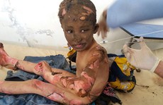 Chấn động em bé Napalm Syria