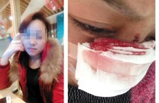 Trung Quốc: Cô gái bị chồng cắt mũi