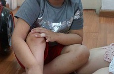 Cậu bé Việt Nam đầu tiên được tài trợ chữa trị viêm da cơ địa