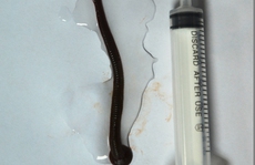 Con đỉa dài 7 cm sống trong cổ cụ bà hơn 2 tháng