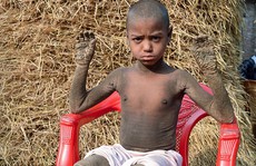 Cậu bé “hóa đá” vì căn bệnh hiếm gặp