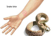 Trẻ bị động vật cắn, xử trí ra sao?