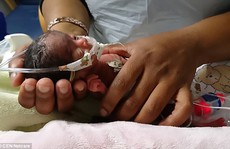 Sinh non nặng 395 g, bé gái tí hon gây choáng váng