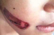 Sự thật vụ bé gái bị cha đẻ và mẹ kế bạo hành dã man