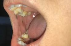 Một phụ nữ Bến Tre mắc bệnh cực kỳ hiếm gặp