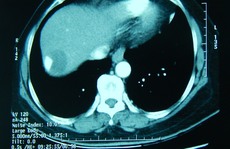 Loại bỏ khối u gan khổng lồ ở bệnh nhân nữ 67 tuổi