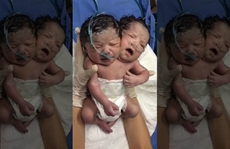 Em bé chào đời với 2 đầu