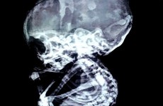 Tá hỏa phát hiện em bé 'hóa đá' ở trong bụng mẹ suốt 15 năm