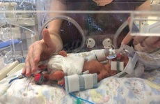 Cặp song sinh sinh non sống sót nhờ được mẹ... đựng trong túi ni lông