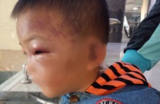 Bé 2 tuổi thâm tím mặt, nhập viện nghi bị bố dượng bạo hành