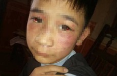 Con trai 'tố' cha đẻ cùng mẹ kế bạo hành thâm tím khắp người
