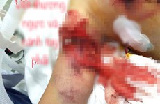 Pháo nổ toác cánh tay bé gái