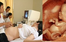 Mẹ bầu siêu âm nhiều có ảnh hưởng thai nhi không?