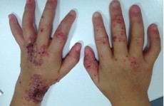 Bé gái bị lây bệnh tình dục vì nụ hôn của cha