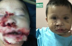 Đang chơi với chó con, bé trai 2 tuổi bị chó mẹ cắn nát mặt