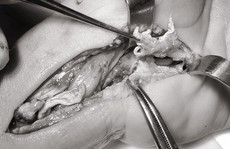 Cổ tay 'bầy nhầy' vì chích corticoid trị hội chứng ống cổ tay