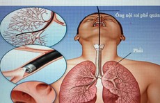 Nữ bệnh nhân tử vong sau nội soi phế quản do mất máu nhiều