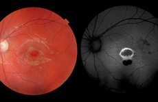 Bé trai thủng mắt vì nhìn vào bút laser