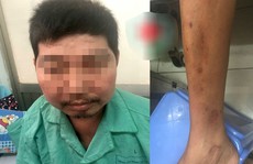 Uống thuốc Đông y 'ngậm' corticoid, người đàn ông 'to không đều'