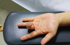 Ai dễ mắc bệnh lý ngón tay lò xo?