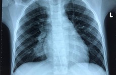 Qua 3 bệnh viện, ca bệnh phổi hiếm gặp được cứu