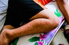 Bệnh sởi đang gia tăng ở Bình Dương