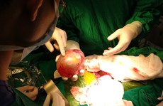 Phát hiện khối u thai kỳ lạ trong bụng bé trai 4 tháng tuổi