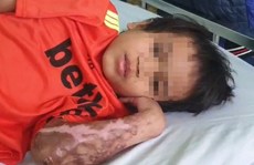 Vụ bác sĩ năn nỉ được cứu chữa cháu bé phỏng nặng: A Huyên đã bình phục, xuất viện