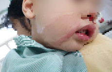 Nhỏ nhầm axit để rửa mũi khiến bé trai bị bỏng nặng