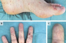 Cảnh báo: bị thú cưng cắn, sốt và chết