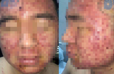 Mặt nam thanh niên 22 tuổi chi chít mụn trứng cá sau khi bôi thuốc mua trên mạng