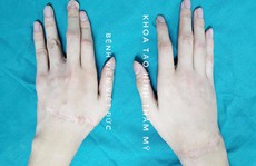 Thanh niên 19 tuổi gõ máy tính nhoay nhoáy sau nối liền hai bàn tay đứt rời