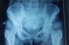 Người đàn bà 34 tuổi bị 'dị vật chui vào người' mà không biết