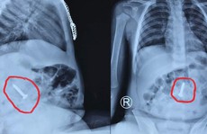 Đinh vít bằng sắt dài 3,5 cm nằm trong tá tràng cháu bé 20 tháng tuổi