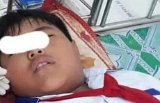 Chuyện hy hữu: Cây xiên que đâm xuyên mặt 1 học sinh lớp 4